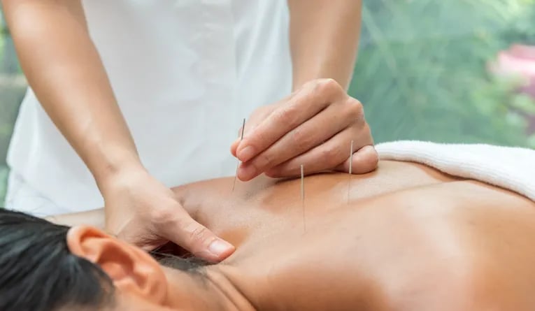 Acupuncture therapy at Chiva-Som